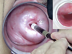 A endoscope asian camera is inserted in the cervix to watch inside the uterus.