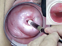 A endoscope asian camera is inserted in the cervix to watch inwards the uterus. A endoscope asian camera is inserted in the cervix to watch inwards the uterus.