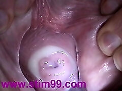 Insertion Man-lava in Cervix Pussy Speculum. Cum in Uterus Insertion Man-lava in Cervix Pussy Speculum. Cum in Uterus