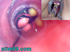 mature femme, peehole endoscope caméra dans la vessie avec des boules