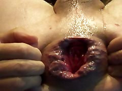 man-cunt gaping prolapse wexxx video hole stretched asshole