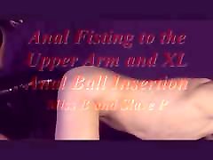 Anal 30 min wale movie xxx to the Upper Arm and XL Anal Ball Insertion