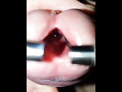 young urethra stretching to maximum, look inside and 10mm dilator inside