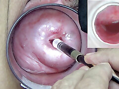 गर्भाशय के अंदर देखने के लिए small boy black dose girl ग्रीवा में एक एंडोस्कोप जापानी कैमरा डाला जाता है ।